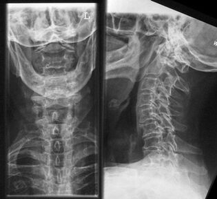 Servikal omurganın röntgeni - osteokondrozu teşhis etmek için bir yöntem