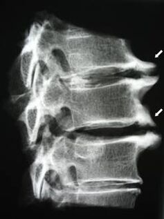 Servikal omurganın osteofitleri boyun ağrısına neden olur