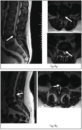 Omurganın fıtıklaşmış diskinin MRI taraması