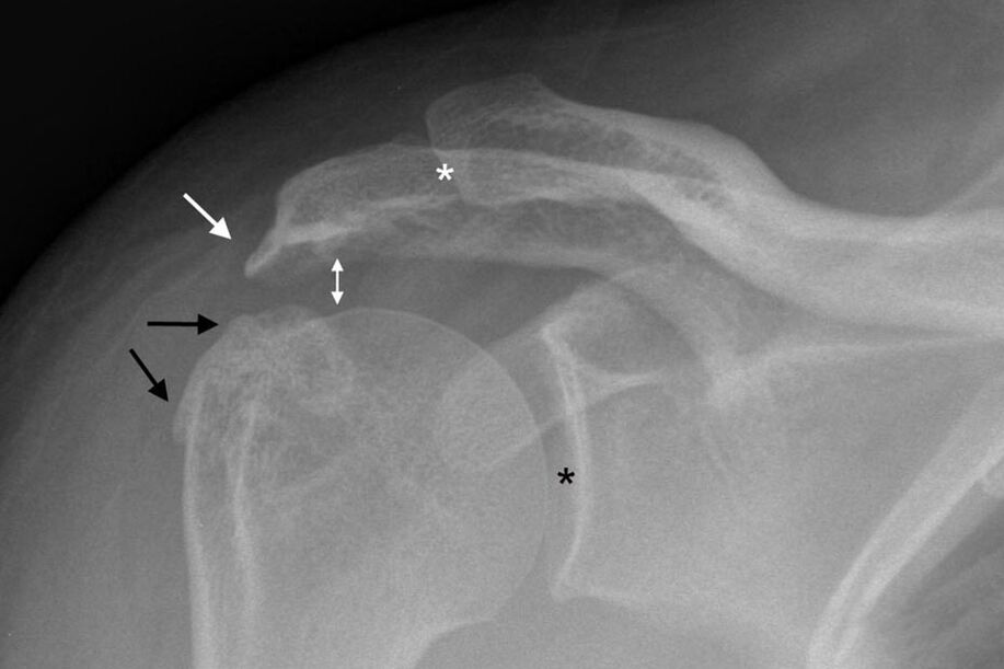 röntgende omuz ekleminin artrozu