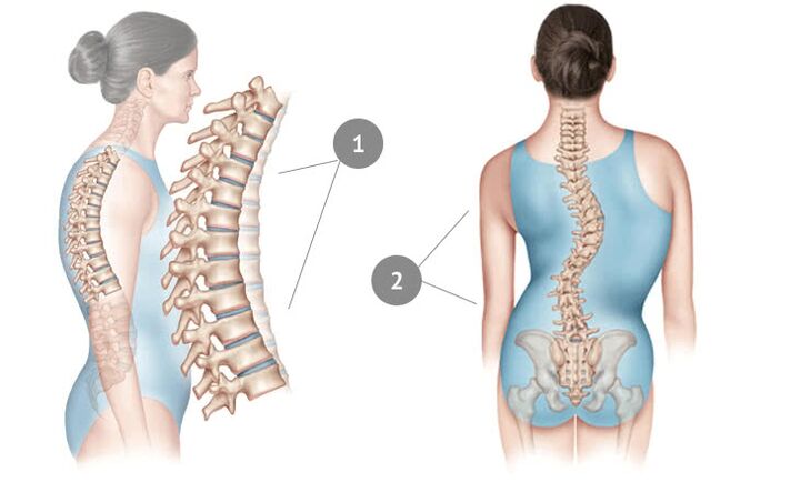 Torasik osteokondrozun bir nedeni olarak spinal eğrilik